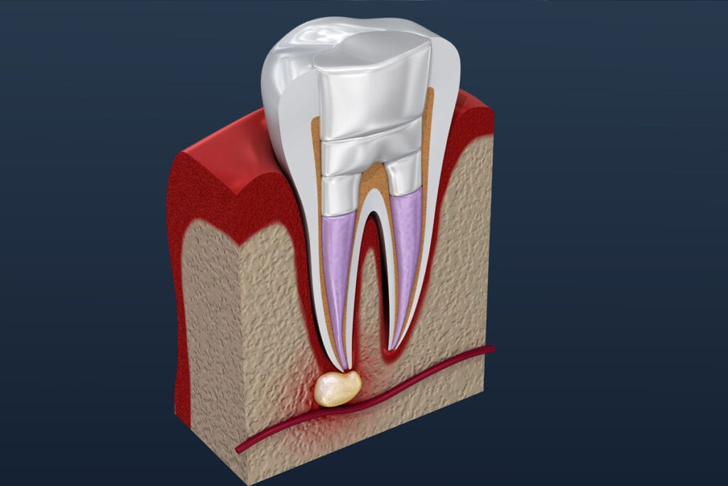 Root Canal Treatment | Central Hutt Dental | Lower Hutt General Dentist