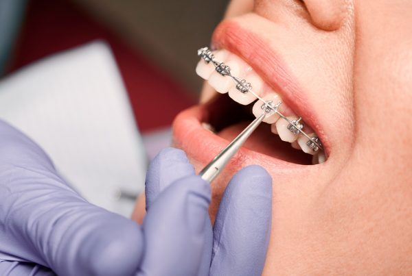 Braces