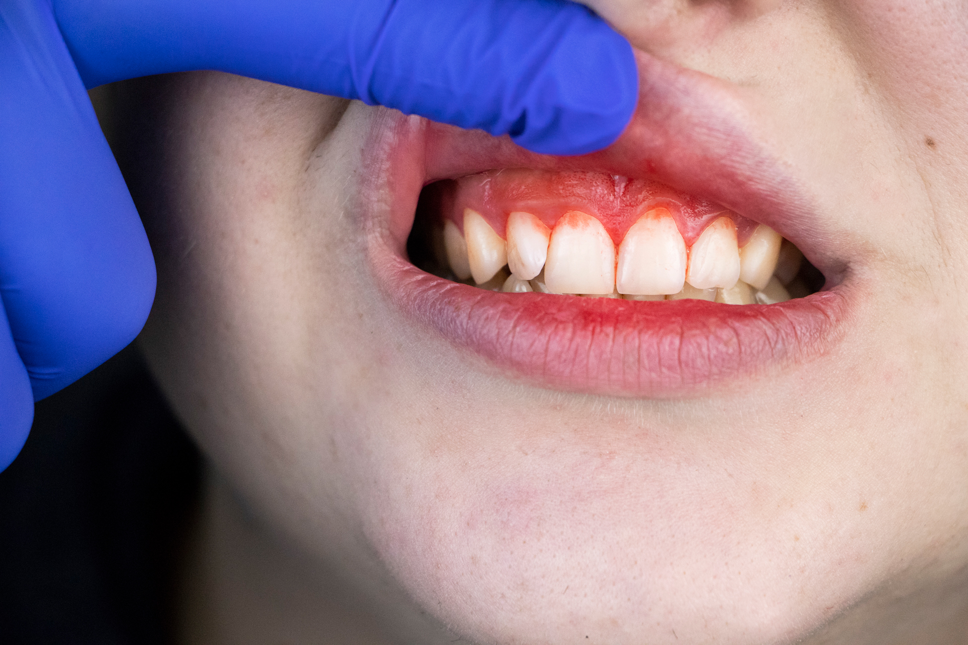 What Is Gum Disease? And How Can I Prevent It?