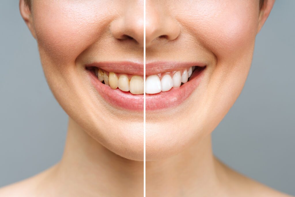 Tips For A Brighter Smile